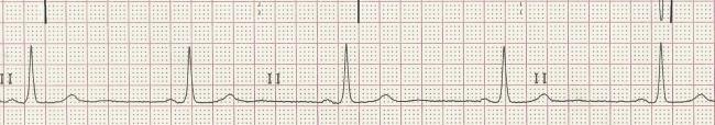 画像をダウンロード Sinus Bradycardia Rhythm 6 Second Strip 231918